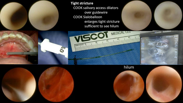 sialendoscopy smg stricture