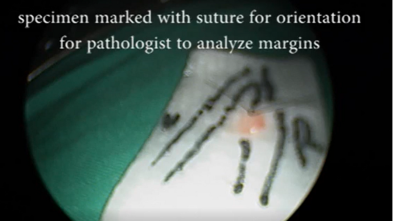 Resection vocal cord lesion with suture orientation