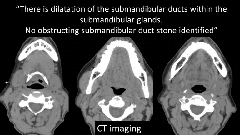 stone not seen on CT US or sialogram