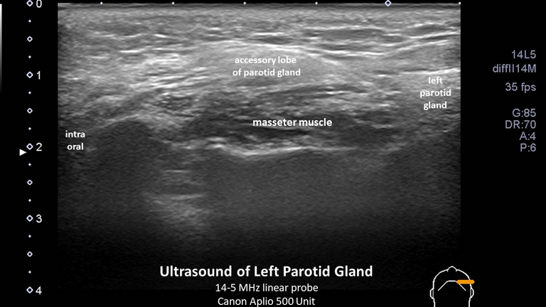 infusion of accessory lobe parotid sialography