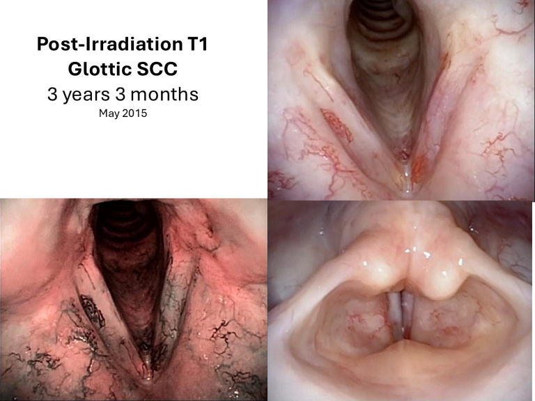 T1 post XRT long term sequence