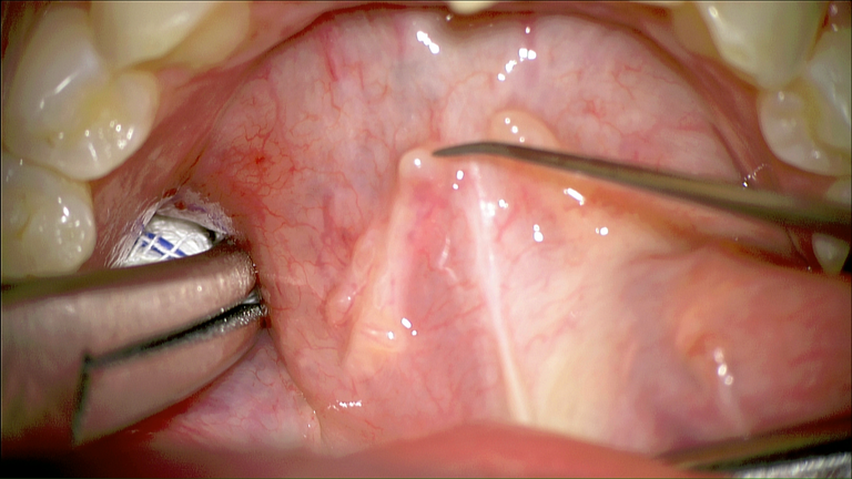 SMG cannulation with Prolene and 26 gauge angio