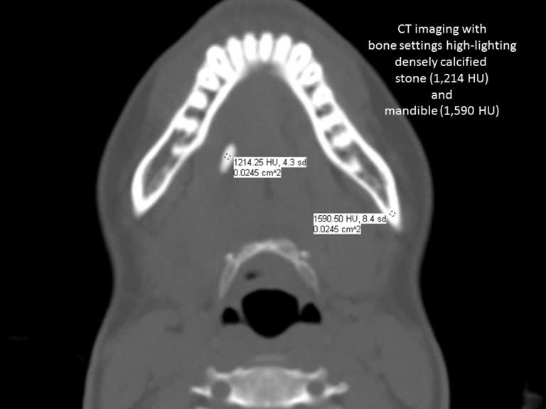 Dense stone imaged on bone windows