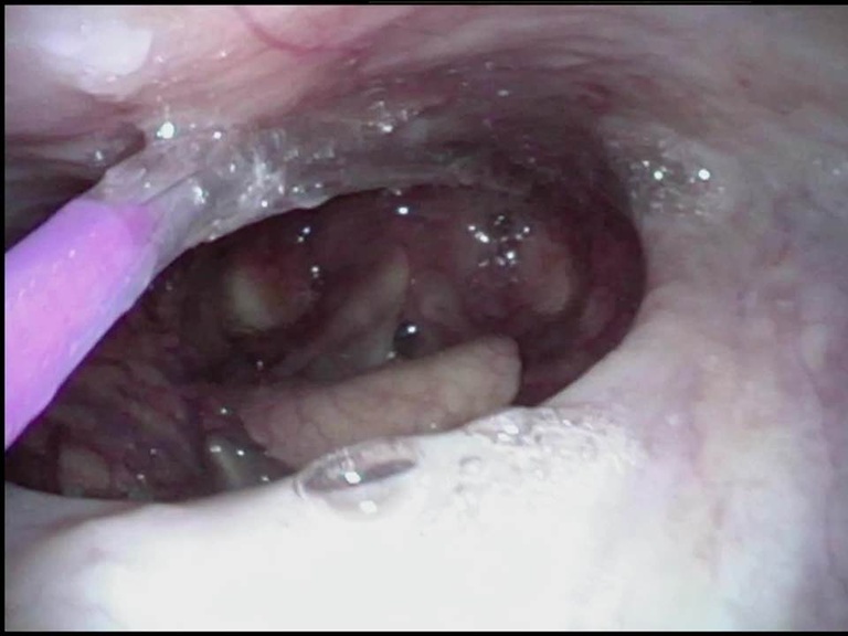 Difficulties in positioning tip of ballon into laryngeal introitus