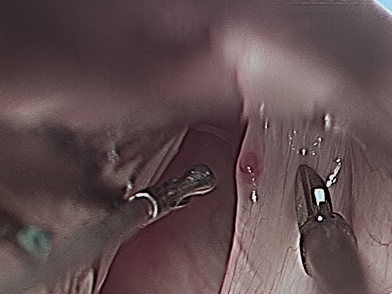Intraop Microdirect Laryngoscopy with Resection