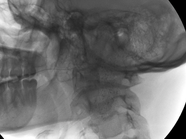 Left parotid sialogram following infusion of 2 cc of Isovue 370 through 22 gauge angicatheter