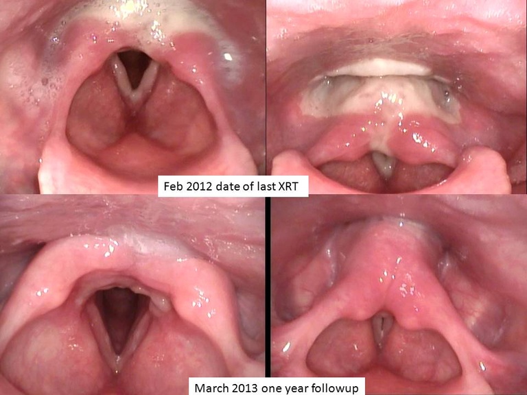  c Larynx seen in clinic on last day of XRT and one year later    