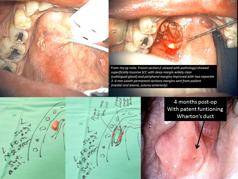 Duct cannulation and sialendoscopy to aid in floor of mouth resection