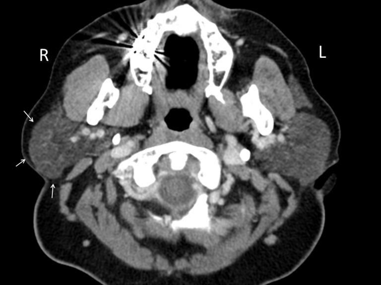 CT imaging white arrows show right parotid enlargement