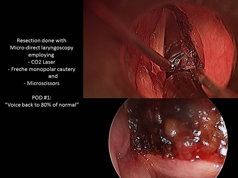 Excision of laryngeal mass