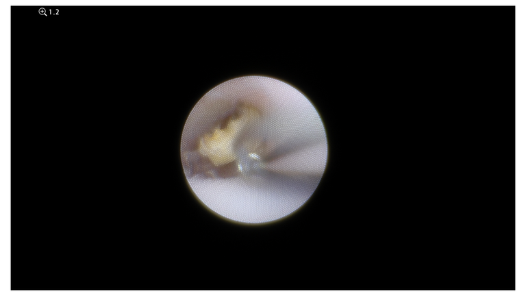 laser sialendoscopy for parotid stone