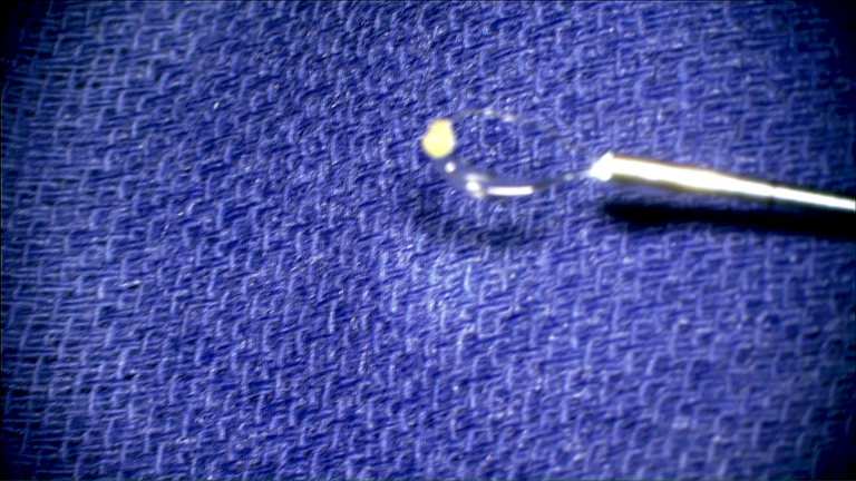 laser sialendoscopy for parotid stone