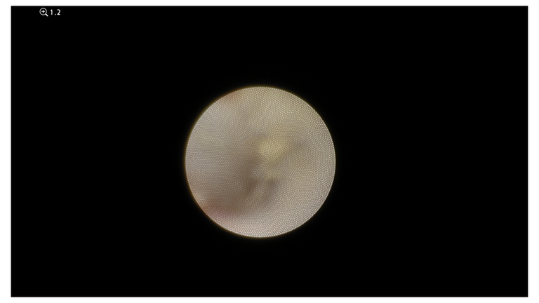laser sialendoscopy for parotid stone