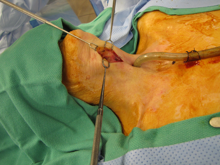 Near-Field Laryngectomy Sequence