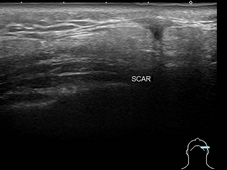 Lymphadenoma parotid