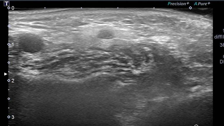 Botox® for sialadenitis after parotidectomy