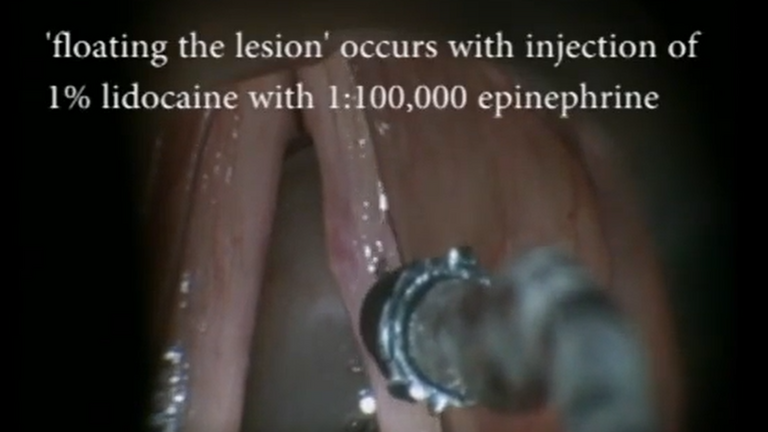 Resection vocal cord lesion with suture orientation