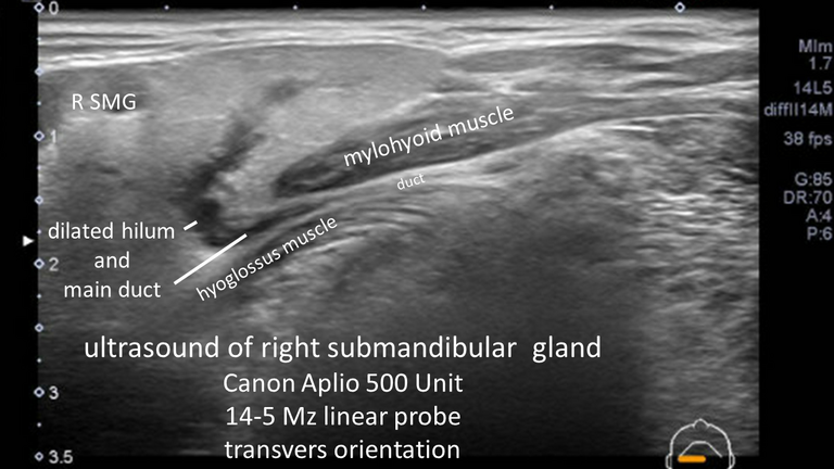 stone not seen on CT US or sialogram