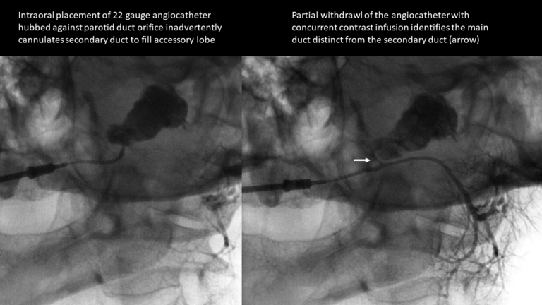 inadvertent cannulation of secondary duct to accessory lobe of parotid