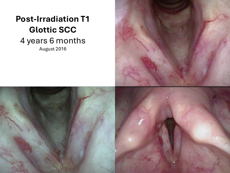 T1 post XRT long term sequence