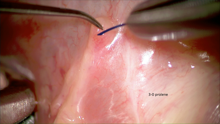 SMG cannulation with Prolene and 26 gauge angio