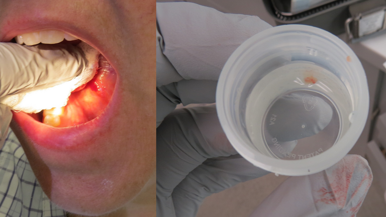 floor of mouth mucus retention cyst with rupture (mucus extravasation phenomenon).