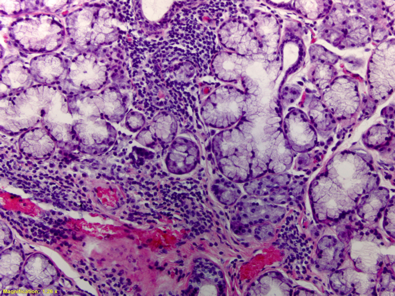 Inflammation is predominantly or exclusively composed of lymphocytes (a minor proportion of plasma cells is allowed) centered around acini as seen here