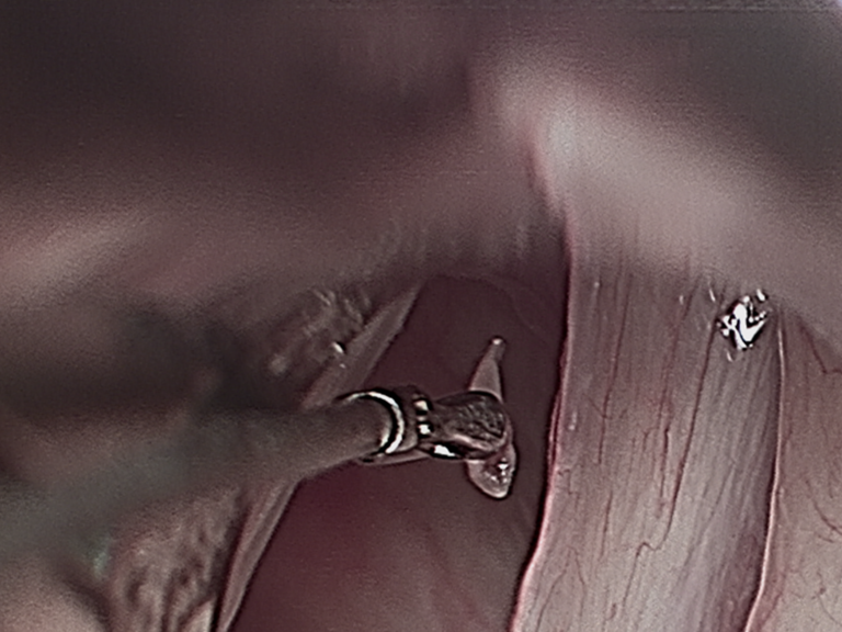 Intraop Microdirect Laryngoscopy with Resection