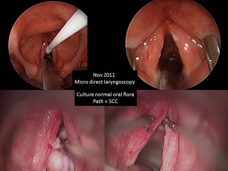 a Diagnosis made from bx at time of microdirect laryngoscopy