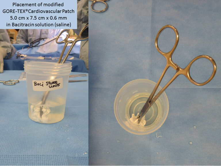 The newly fashioned strip is stored in Bacitracin solution to prepare for implantation