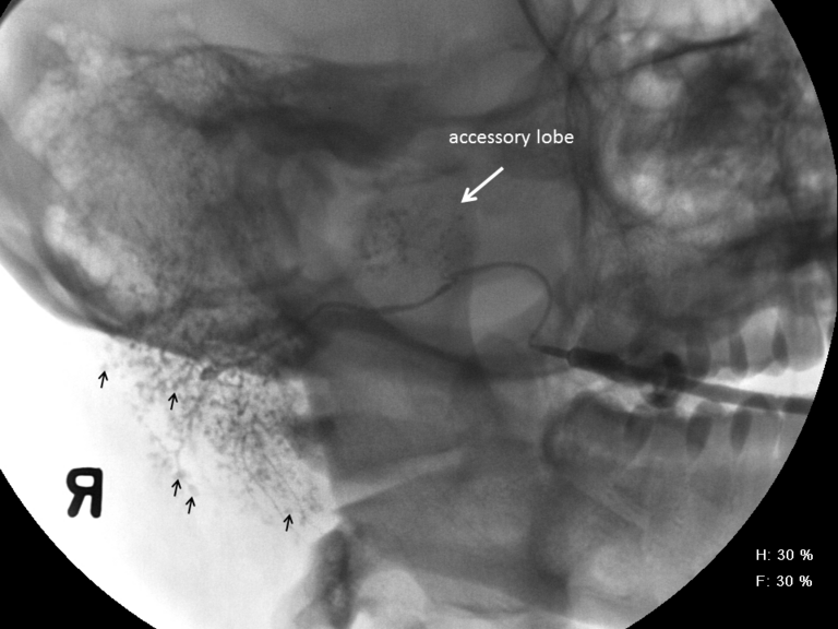 Right parotid sialogram identifies pooling of contrast in damaged acini with a mild ductal narrowing proximal to take off for accessory lobe 