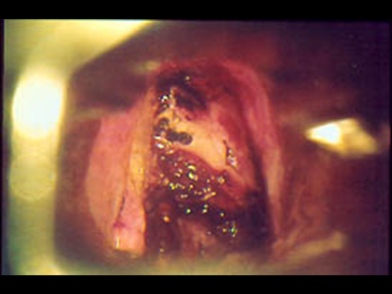 Endoscopic view after laser resection with positive margins
