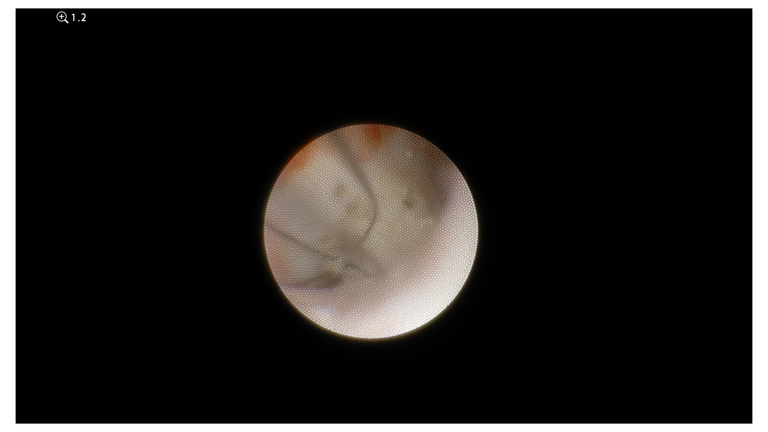 laser sialendoscopy for parotid stone