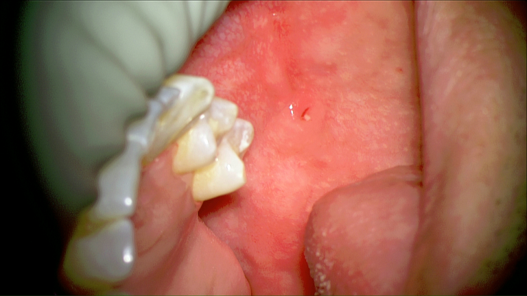 laser sialendoscopy for parotid stone
