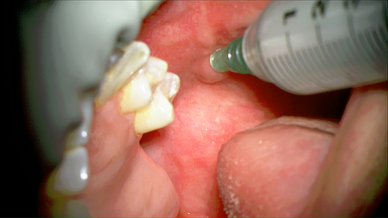laser sialendoscopy for parotid stone