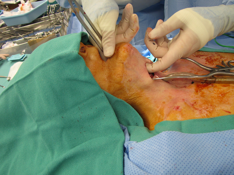 Near-Field Laryngectomy Sequence