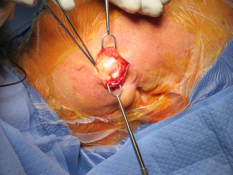 Lymphadenoma parotid