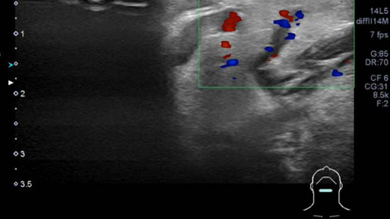 ultrasound and sialogram correlates of submandibular duct obstruction
