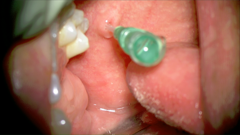 laser sialendoscopy for parotid stone