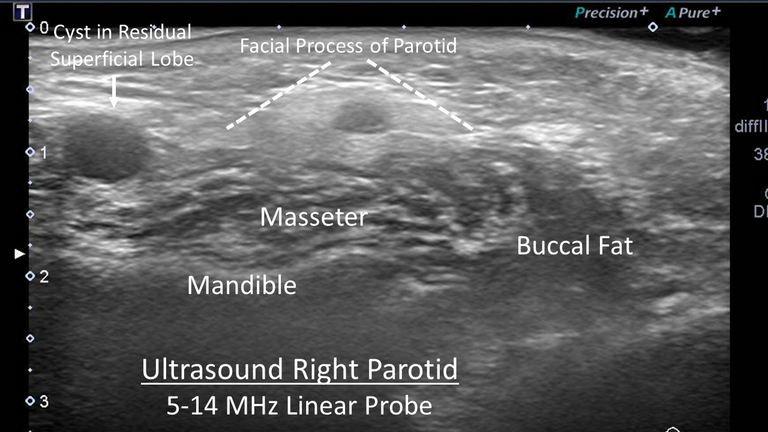 Botox® for sialadenitis after parotidectomy
