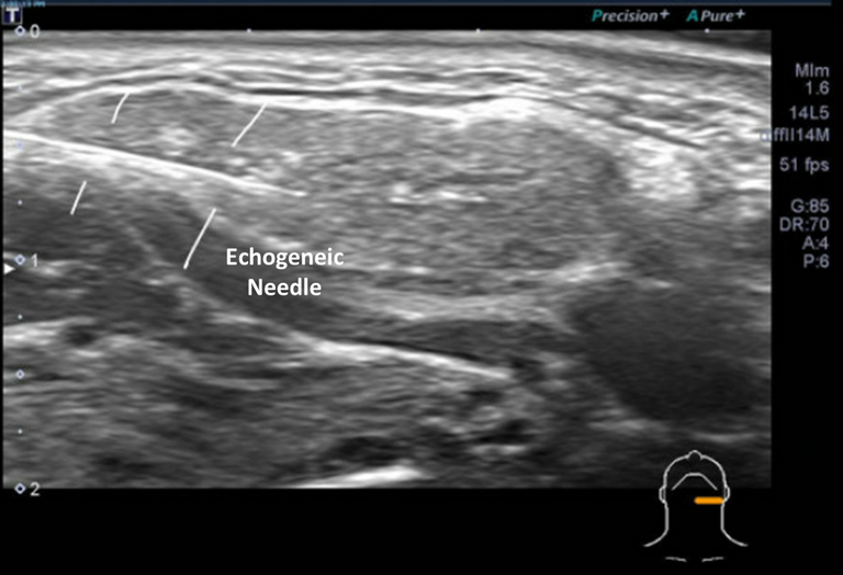echogenic needle for botox infusion