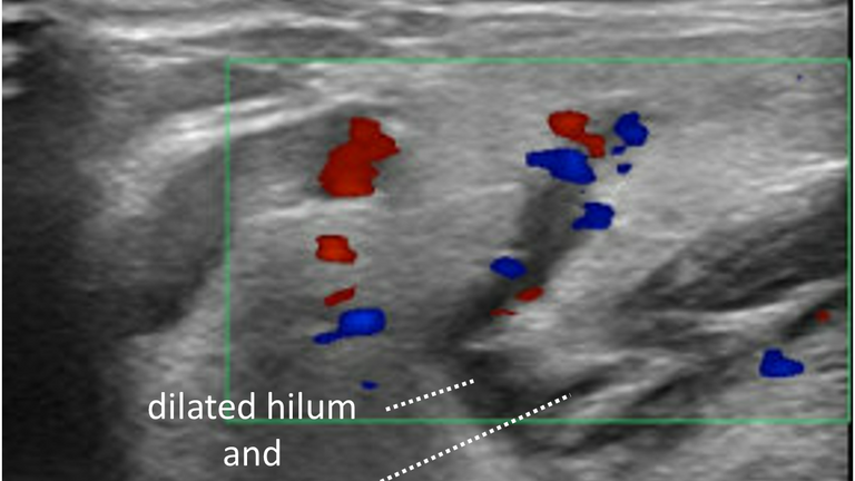 stone not seen on CT US or sialogram