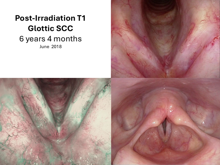 T1 post XRT long term sequence