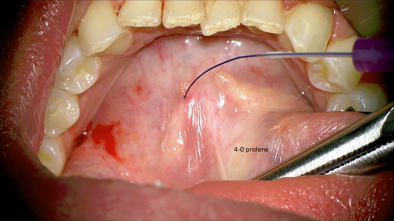 SMG cannulation with Prolene and 26 gauge angio