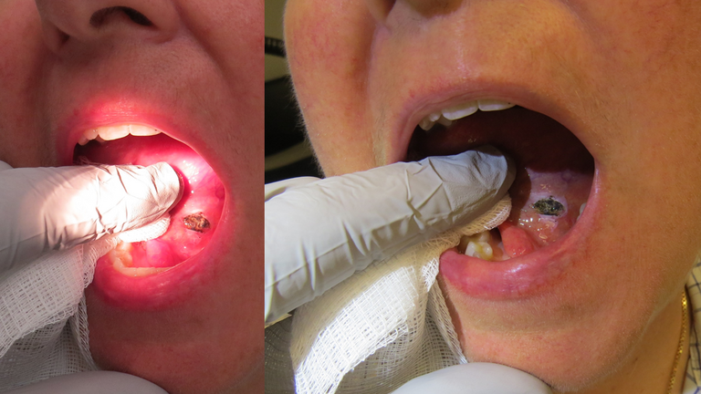 floor of mouth mucus retention cyst with rupture (mucus extravasation phenomenon).
