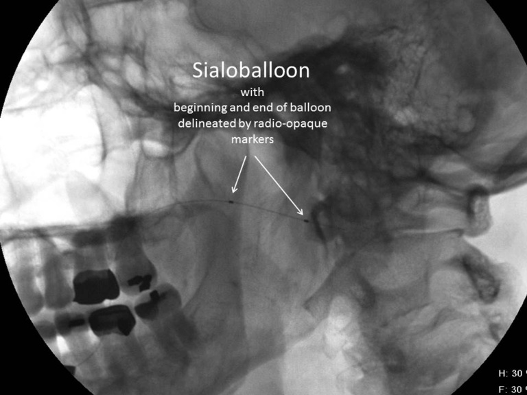 A Salivary balloon in left parotid duct
