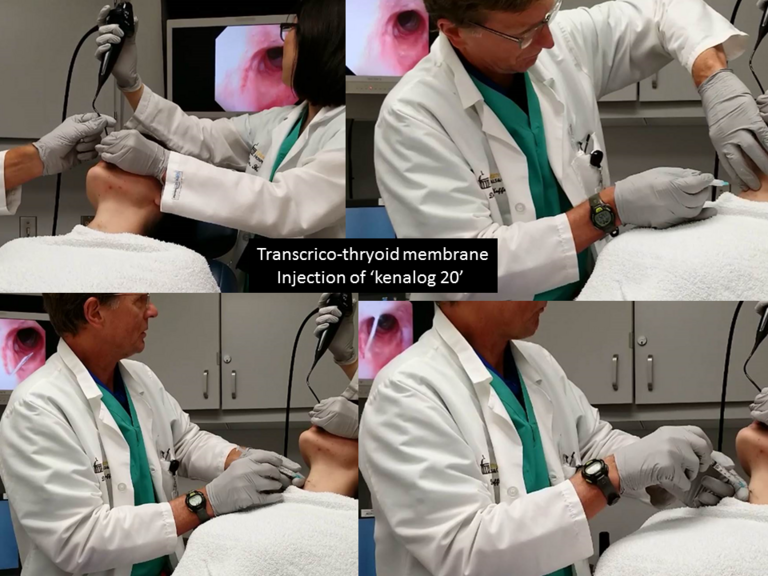 Percutaneous trans-cricothyroid membrane puncture with 25 guage needle to deliver kenalog