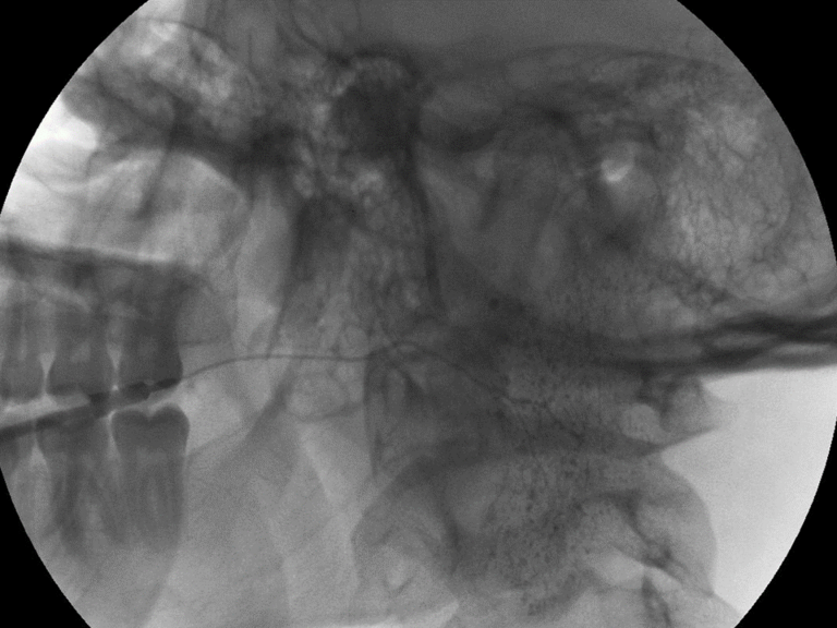 Further infusion of an additional 1 cc of Isovue 370 through 22 gauge angiocatheter in left Stensen's  duct