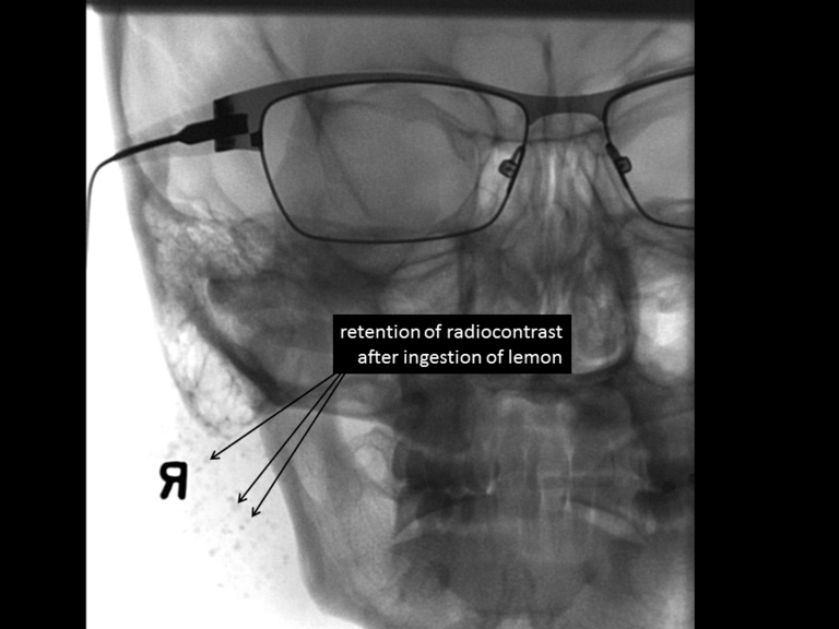 Imaging after ingestion of lemon drops shows only partial clearing with contrast retention in damaged acinar units