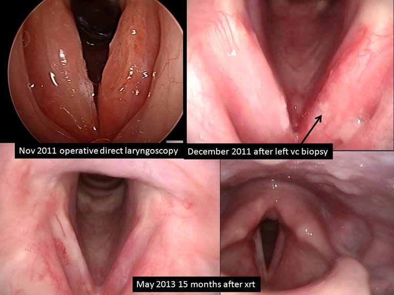 Larynx before irradiation and 15 months after